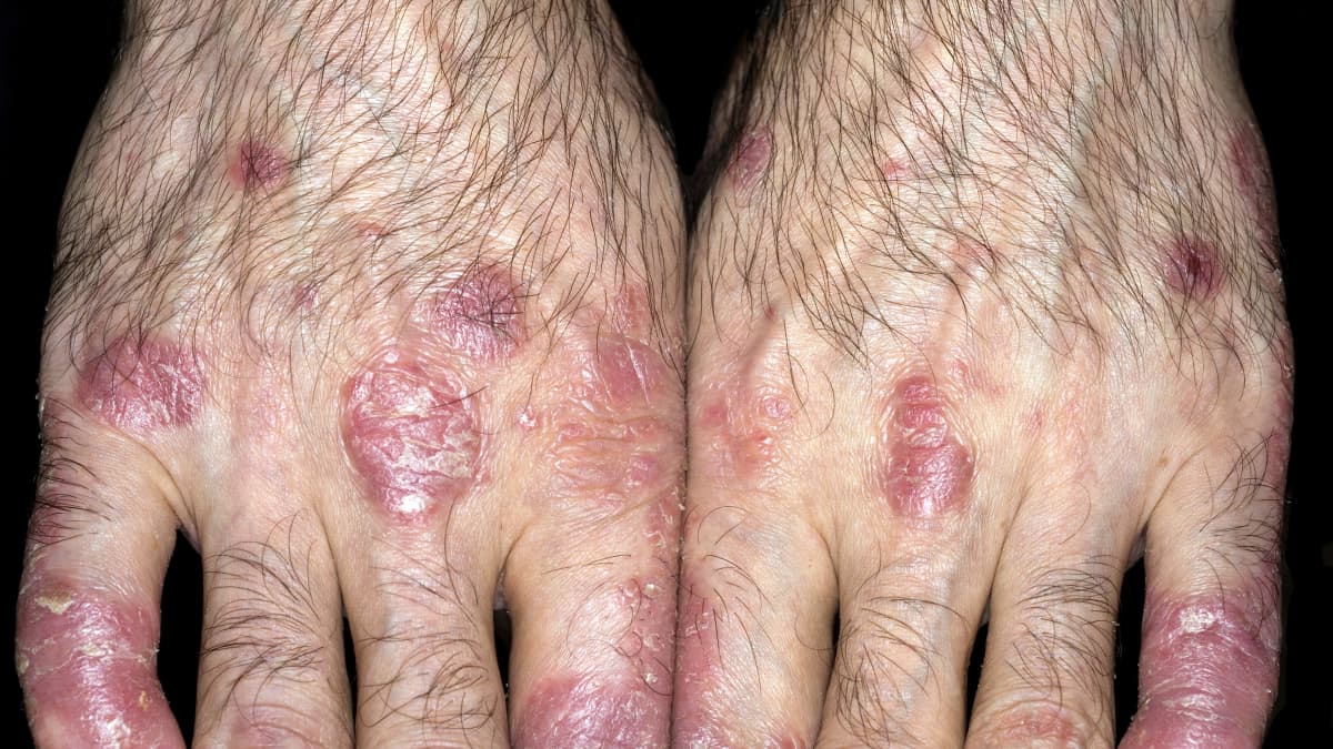 Psoriasis VS Eczema